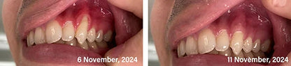 Bee Venom Toothpaste for Sensitive Gums